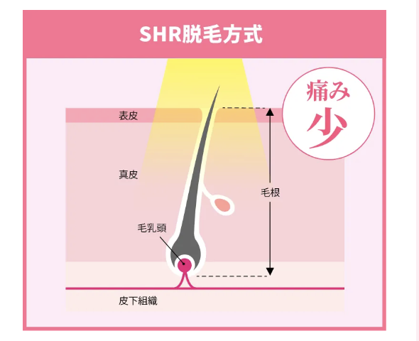 SHR脱毛方式