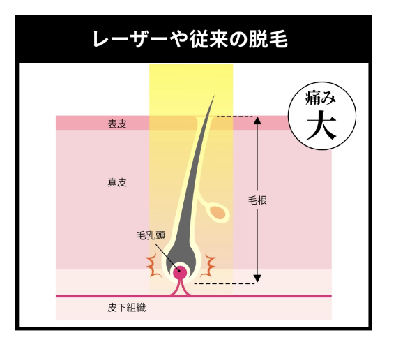 レーザーや従来の脱毛